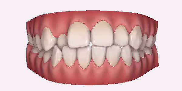 Crossbite