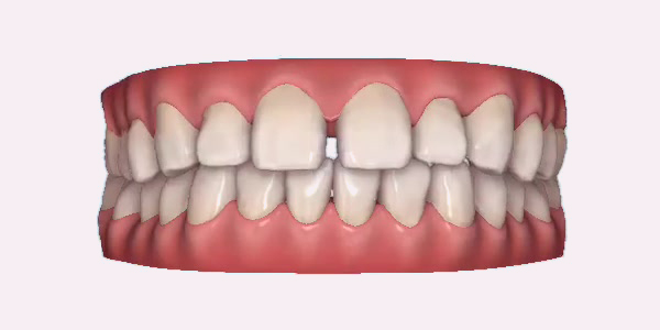 Gapped Teeth